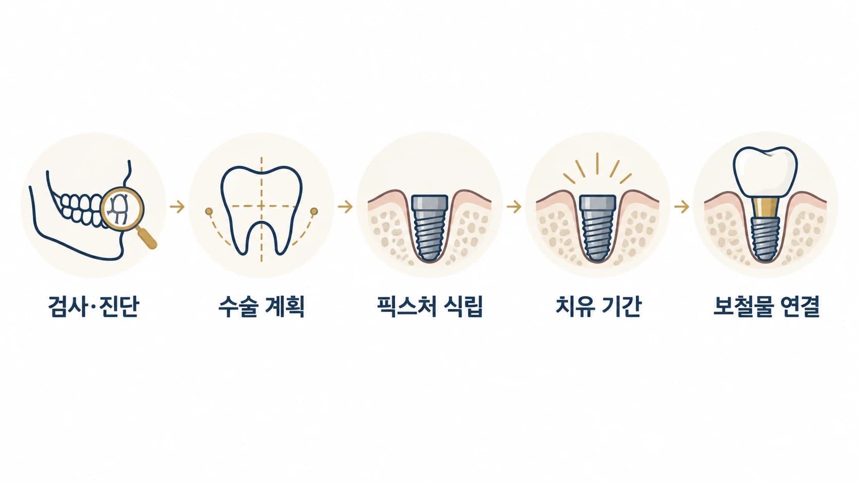 검사·진단, 수술 계획, 식립, 치유 기간, 보철물 제작·연결로 이어지는 임플란트 치료 5단계를 보여주는 흐름도