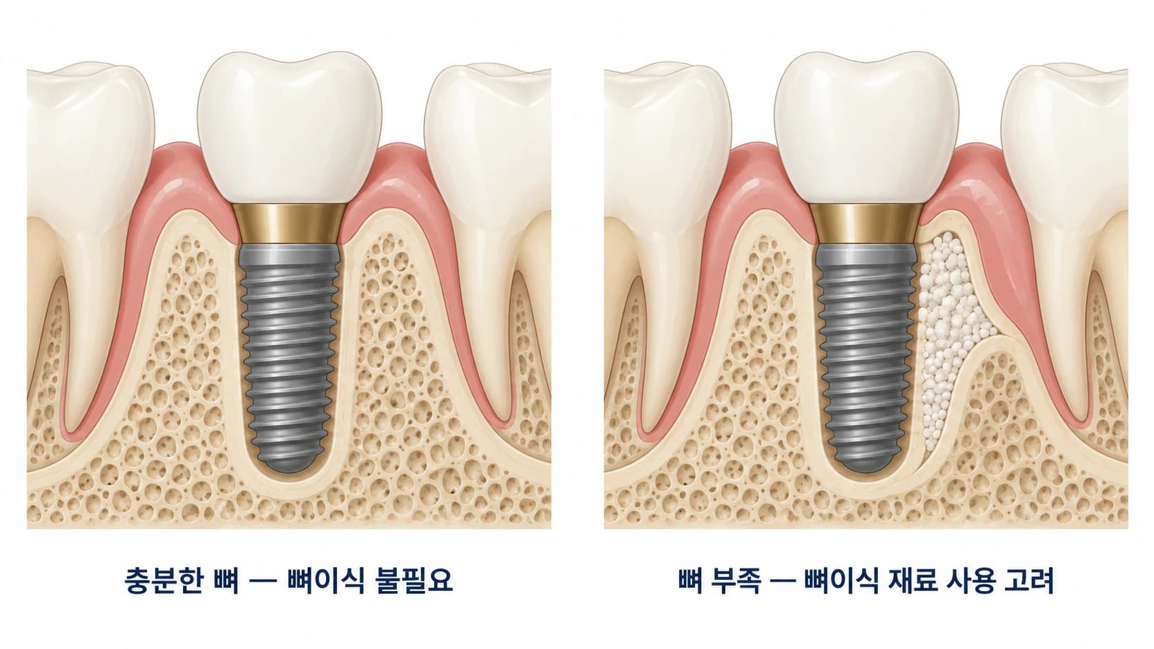 뼈가 충분해 뼈이식이 필요 없는 경우와 뼈가 부족해 뼈이식 재료 사용을 고려하는 경우를 비교한 임플란트 식립 부위 개념도