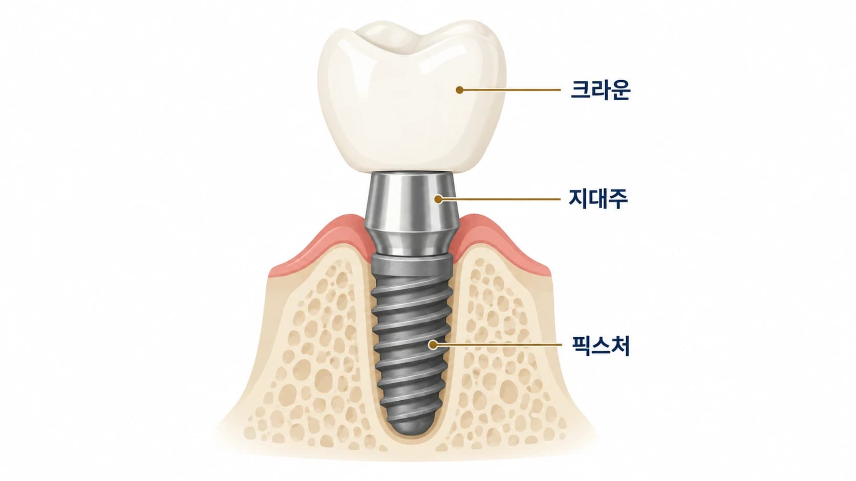 잇몸뼈에 식립된 픽스처, 이를 연결하는 지대주, 눈에 보이는 크라운으로 구성된 임플란트 구조를 보여주는 단면 개념도