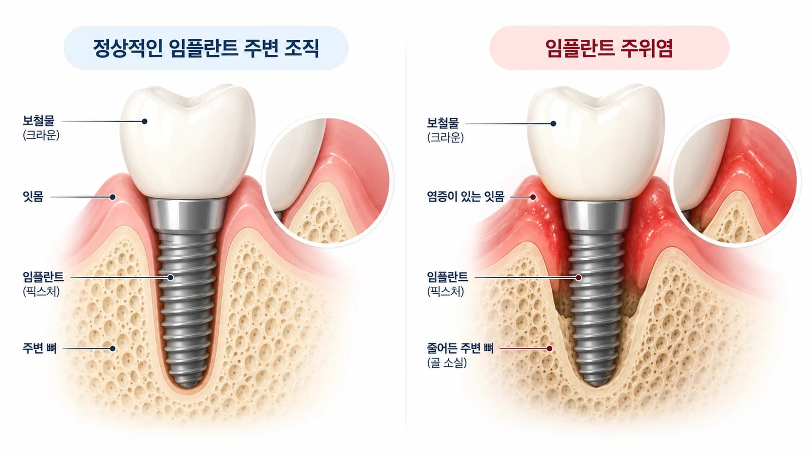 건강한 임플란트 주변 조직과 염증·골 소실이 있는 임플란트 주위염 상태를 비교한 개념도